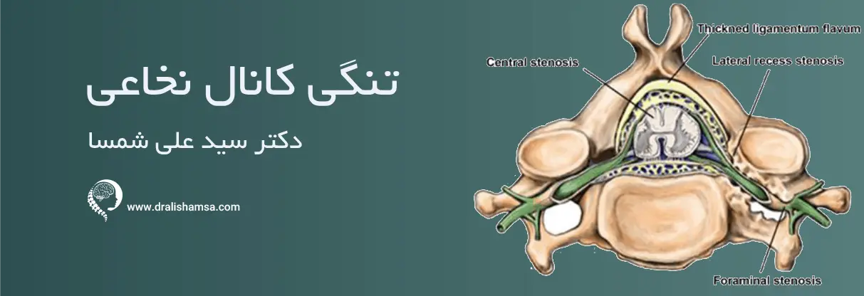 درمان تنگی کانال نخاعی دکتر سید علی شمسا