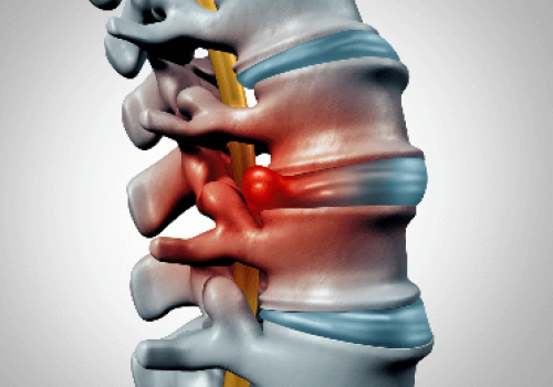 علائم پارگی دیسک گردن علائم پارگی دیسک گردن