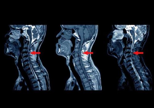 دیسک گردن احتایج به عمل دارد2 دیسک گردن احتایج به عمل دارد2